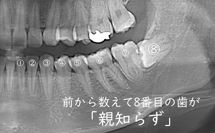 前から数えて8番目の歯が「親知らず」