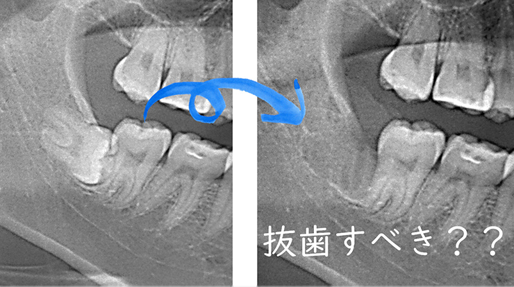 抜歯すべき？？